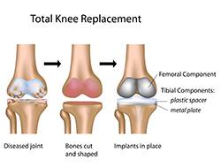 2e1ax_simplistic_entry_totalkneereplaceimage-72dpi