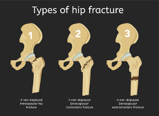 Diagram of hip fracture types