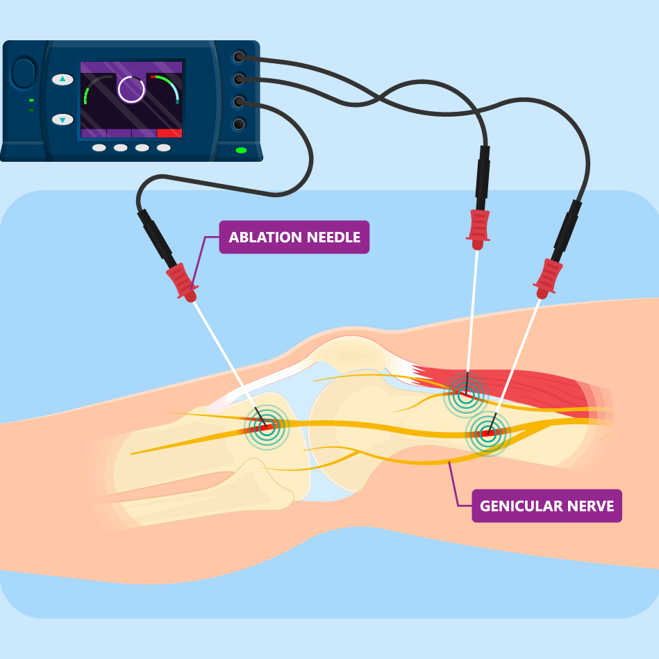 How long does a nerve ablation take?