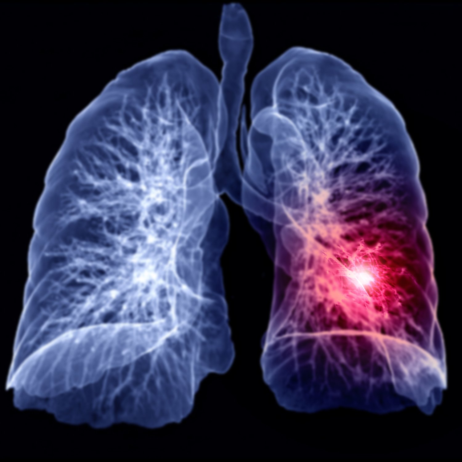 Benign Altid I virkeligheden A CT Scan Can Save Your Lungs and Your Life from Cancer - McLeod Health