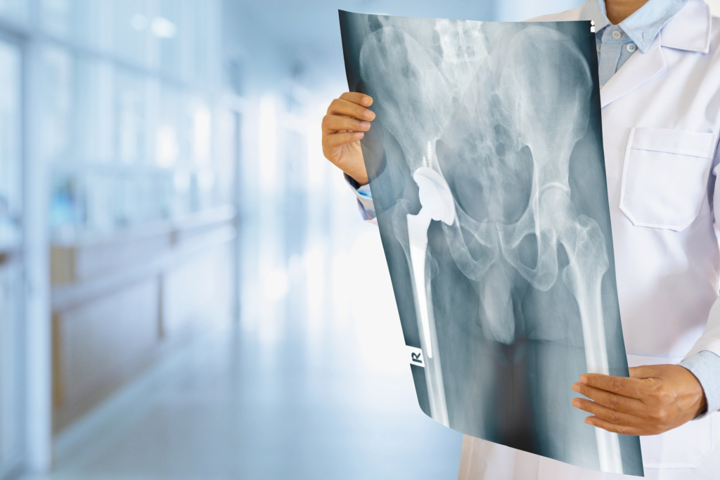 The Difference Traditional vs. Anterior Hip Replacement McLeod Health