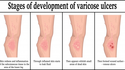 The Developmental Stages of Varicose Veins - Vein Artery