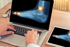 A foot x-ray being displayed on a laptop computer