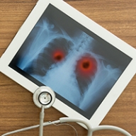 A chest x-ray showing lung cancer tumors