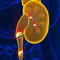 A diagram of a kidney with kidney stones highlighted