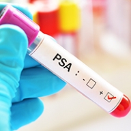 A gloved hand holding a medical vial with PSA written on the side.