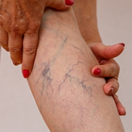 A woman rubbing her leg with prominent veins