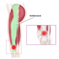 A graphic showing the IT band down the outside of the leg, from the hip to the knee.